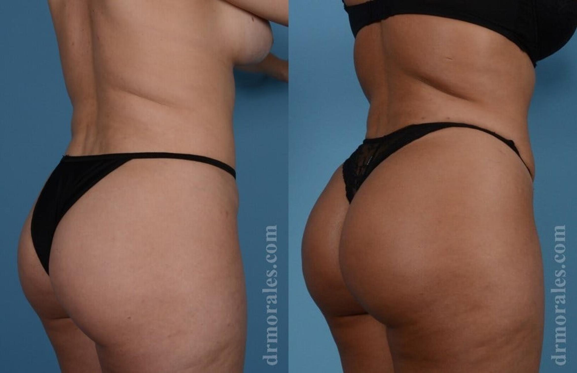 Before & After Brazilian Butt Lift Case 399 View 1 View in Houston, TX