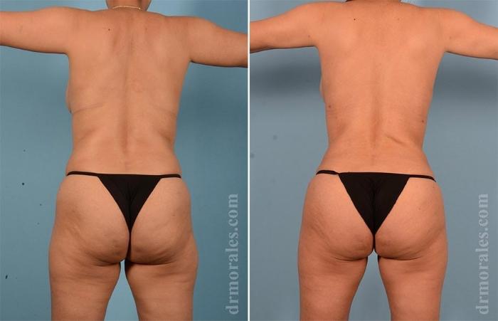 Before & After Brazilian Butt Lift Case 40 View 1 View in Houston, TX