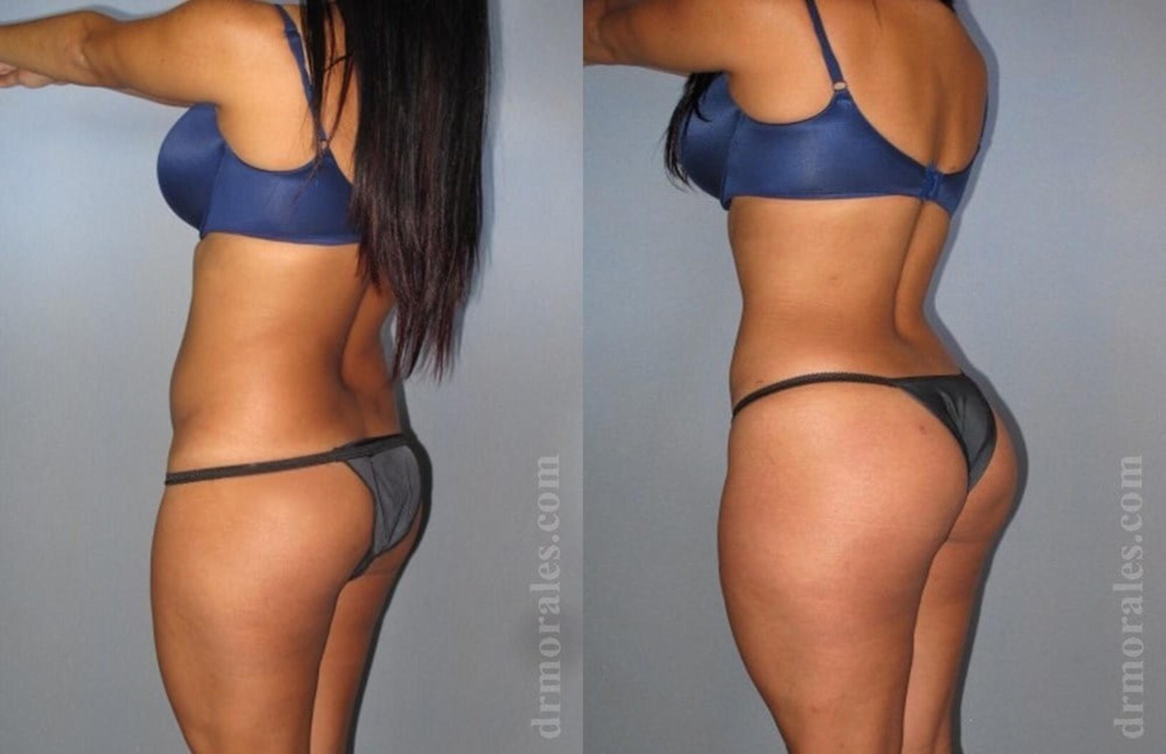 Before & After Brazilian Butt Lift Case 400 View 1 View in Houston, TX