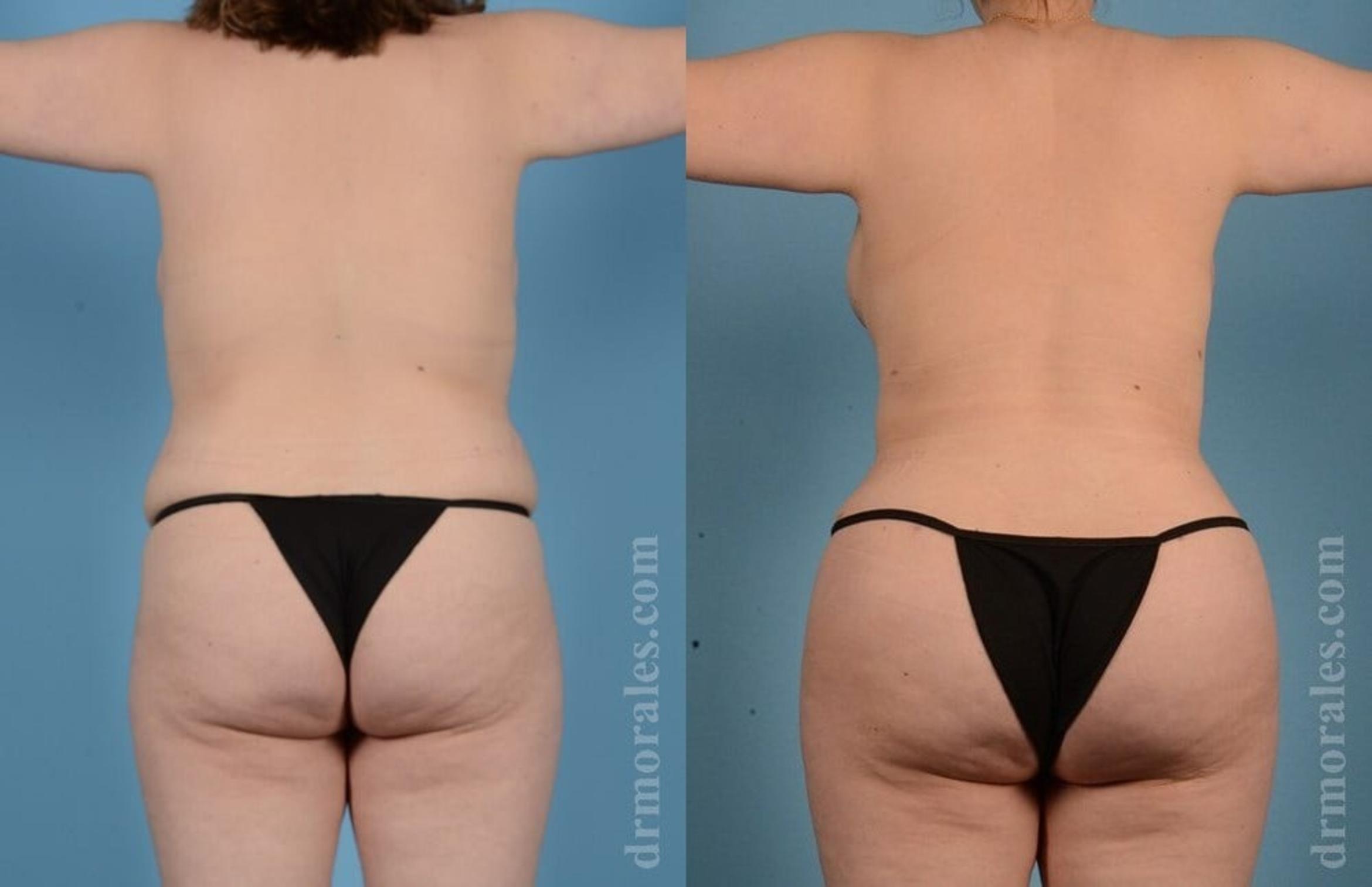 Before & After Brazilian Butt Lift Case 401 View 1 View in Houston, TX