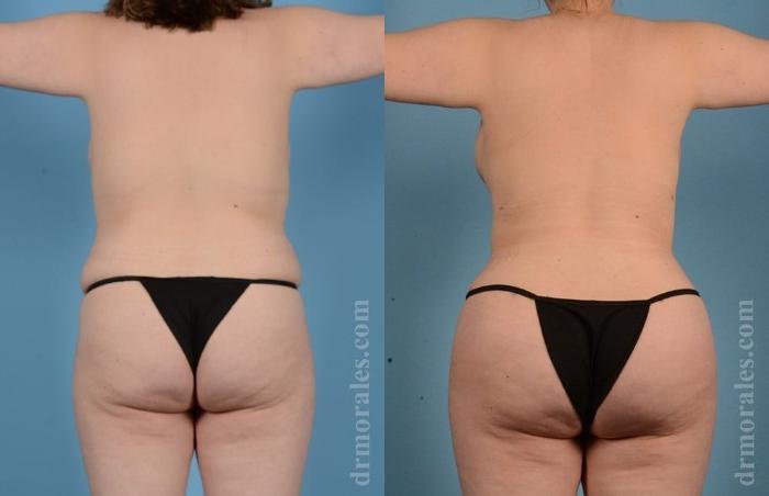Before & After Brazilian Butt Lift Case 401 View 1 View in Houston, TX