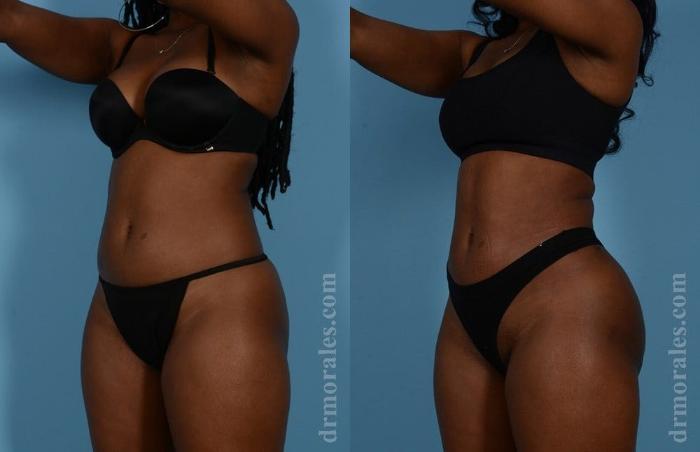 Before & After Brazilian Butt Lift Case 402 View 1 View in Houston, TX
