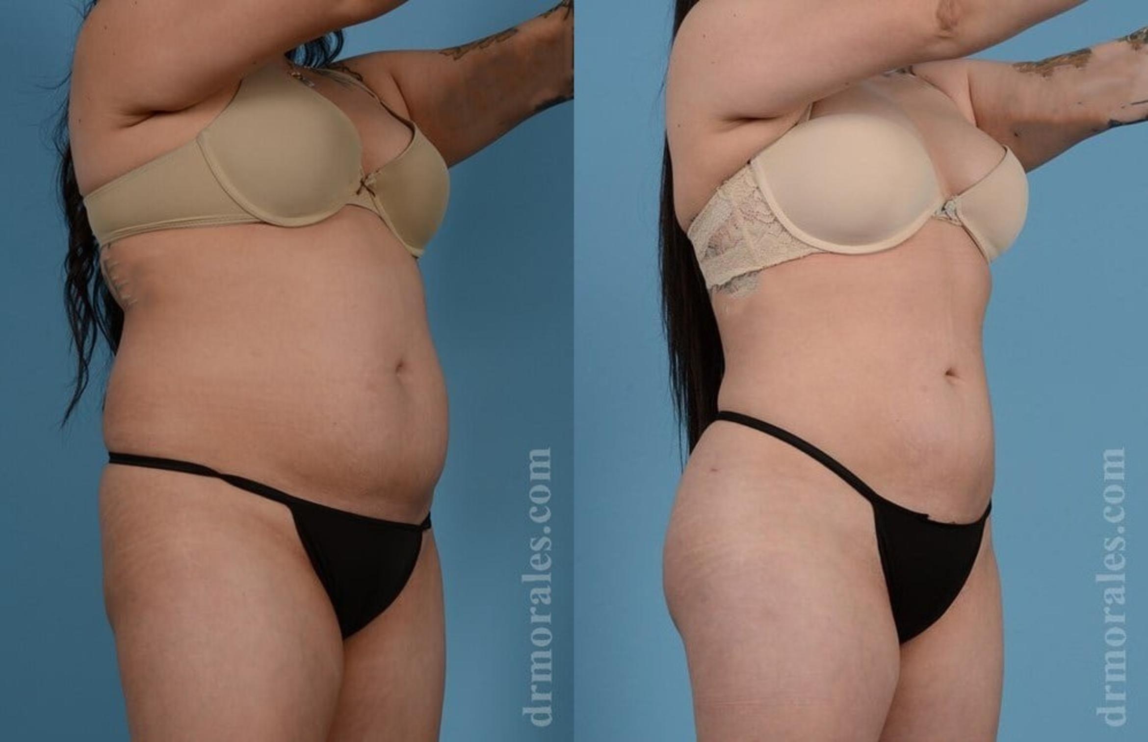 Before & After Brazilian Butt Lift Case 403 View 1 View in Houston, TX