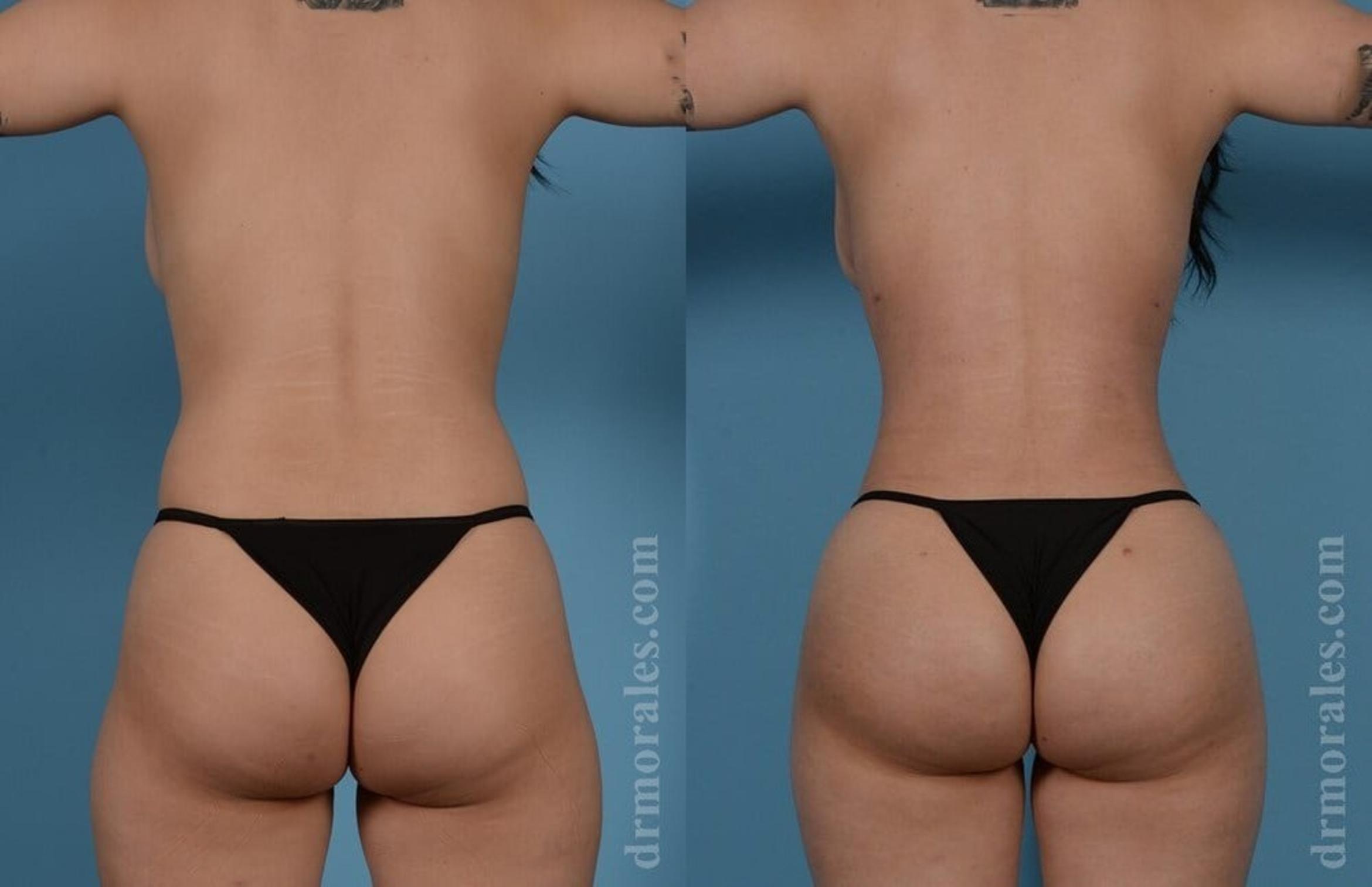 Before & After Brazilian Butt Lift Case 405 View 1 View in Houston, TX
