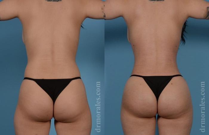 Before & After Brazilian Butt Lift Case 405 View 1 View in Houston, TX