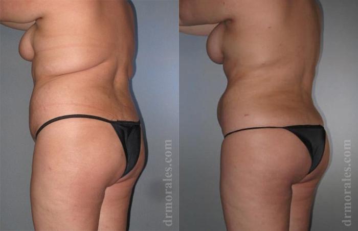 Before & After Liposuction Case 407 View 1 View in Houston, TX