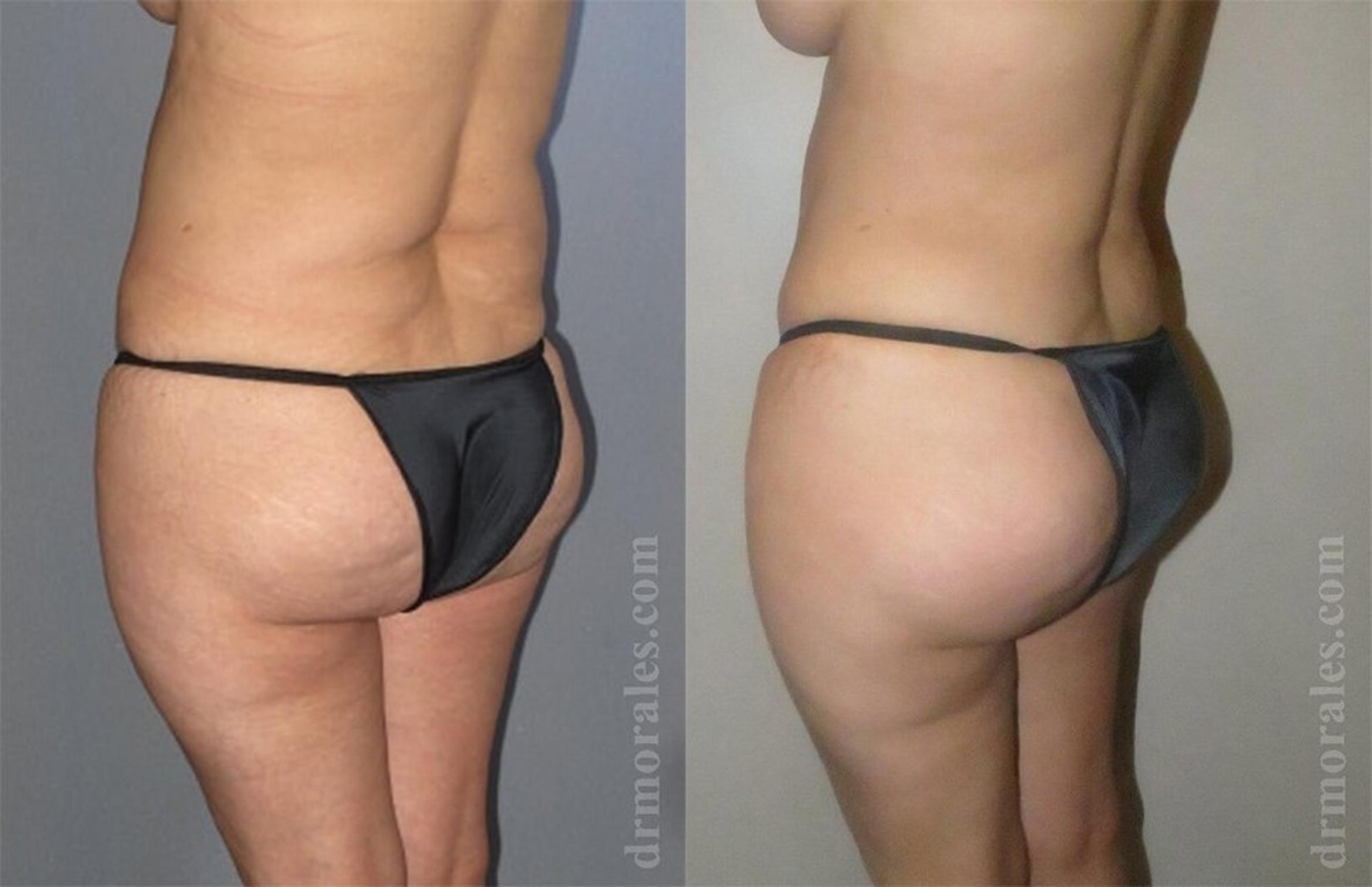 Before & After Brazilian Butt Lift Case 408 View 1 View in Houston, TX