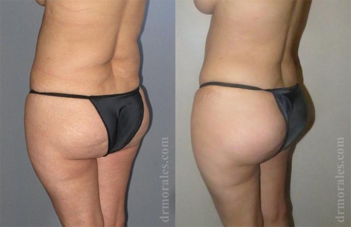 Before & After Brazilian Butt Lift Case 408 View 1 View in Houston, TX