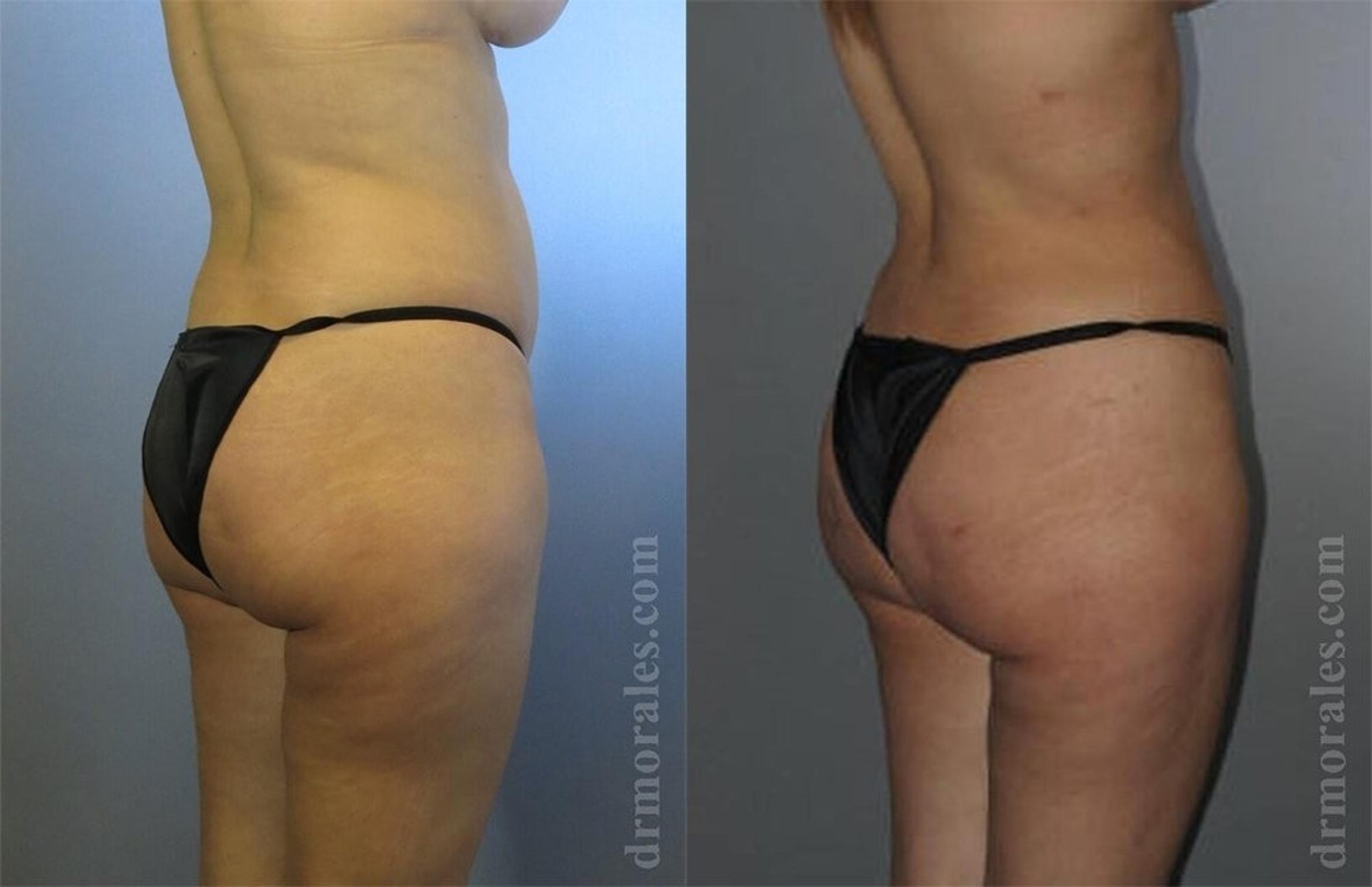 Before & After Liposuction Case 409 View 1 View in Houston, TX