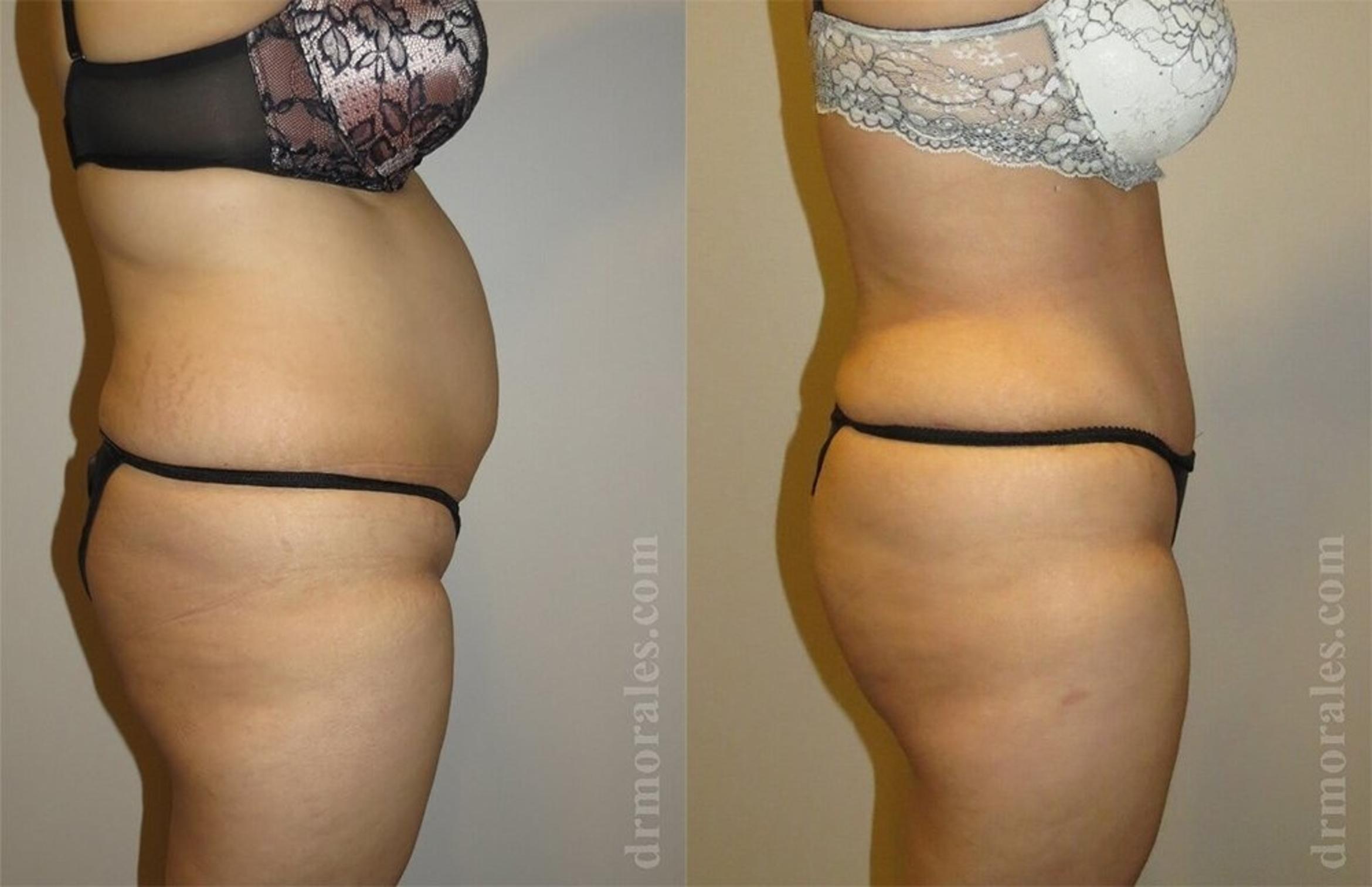 Before & After Brazilian Butt Lift Case 410 View 1 View in Houston, TX