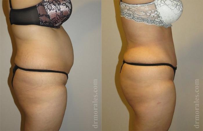 Before & After Brazilian Butt Lift Case 410 View 1 View in Houston, TX