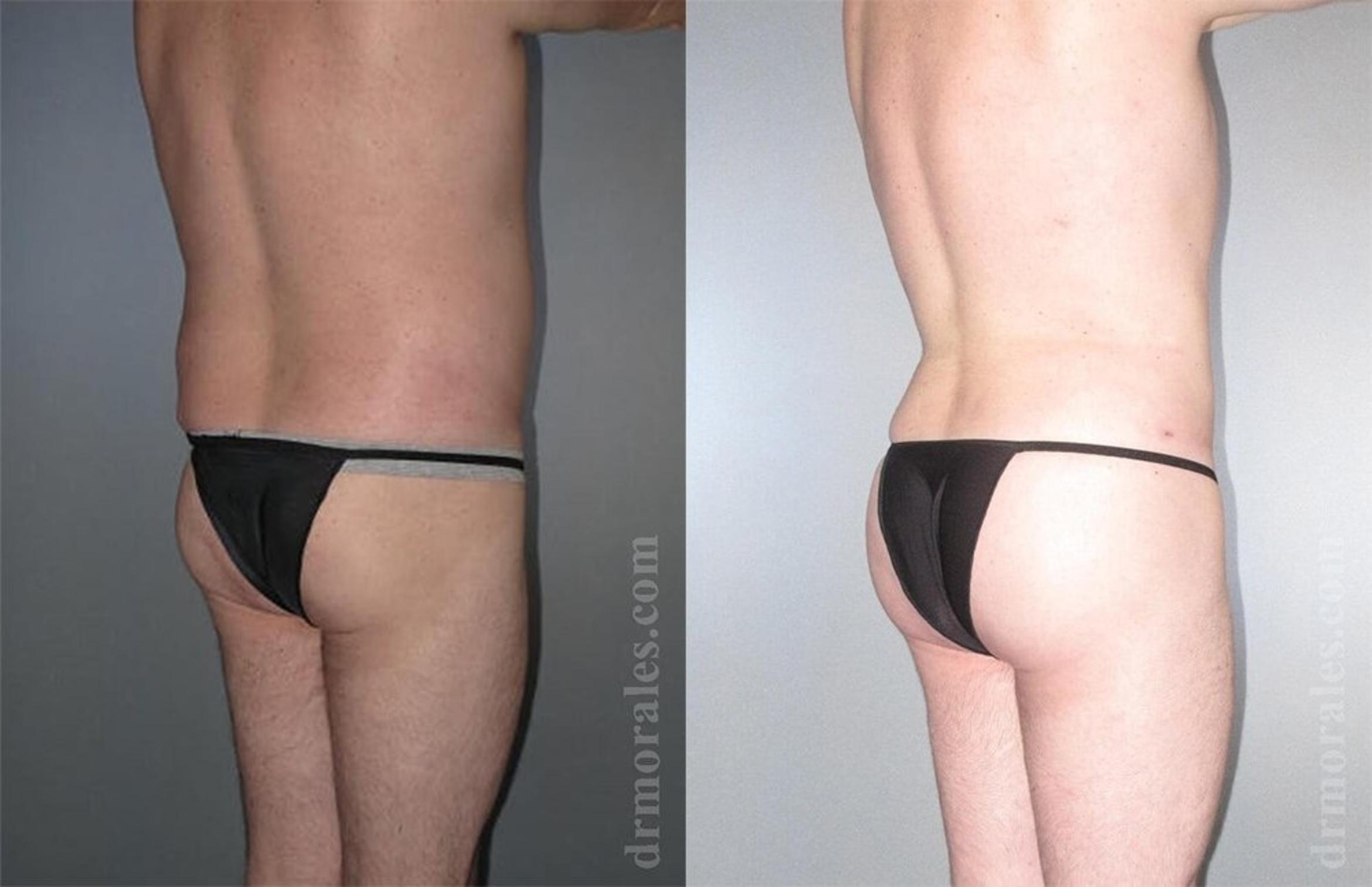 Before & After Brazilian Butt Lift Case 418 View 1 View in Houston, TX