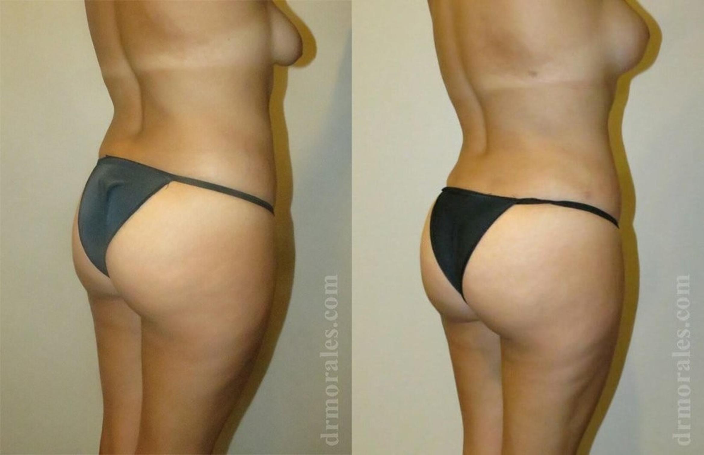 Before & After Liposuction Case 424 View 1 View in Houston, TX