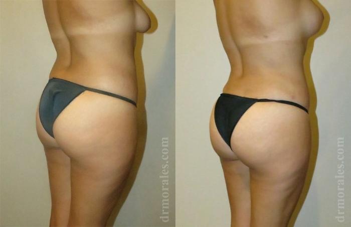 Before & After Liposuction Case 424 View 1 View in Houston, TX