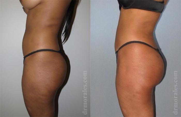 Before & After Liposuction Case 444 View 1 View in Houston, TX