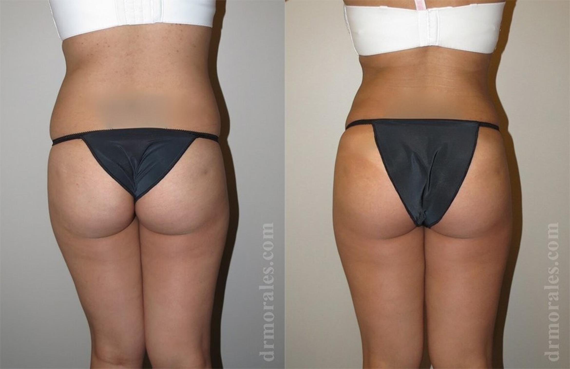 Before & After Liposuction Case 450 View 1 View in Houston, TX