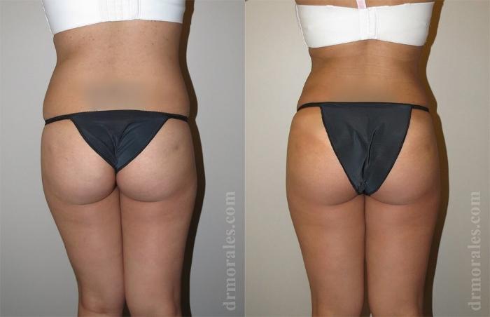 Before & After Liposuction Case 450 View 1 View in Houston, TX