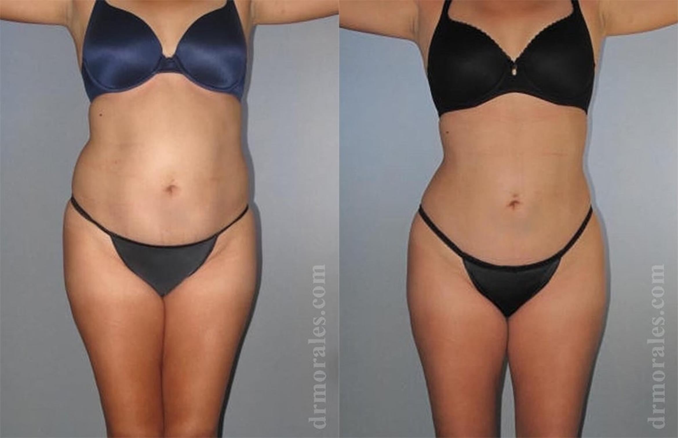 Before & After Brazilian Butt Lift Case 454 View 1 View in Houston, TX