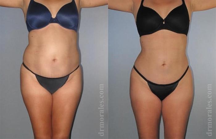 Before & After Brazilian Butt Lift Case 454 View 1 View in Houston, TX