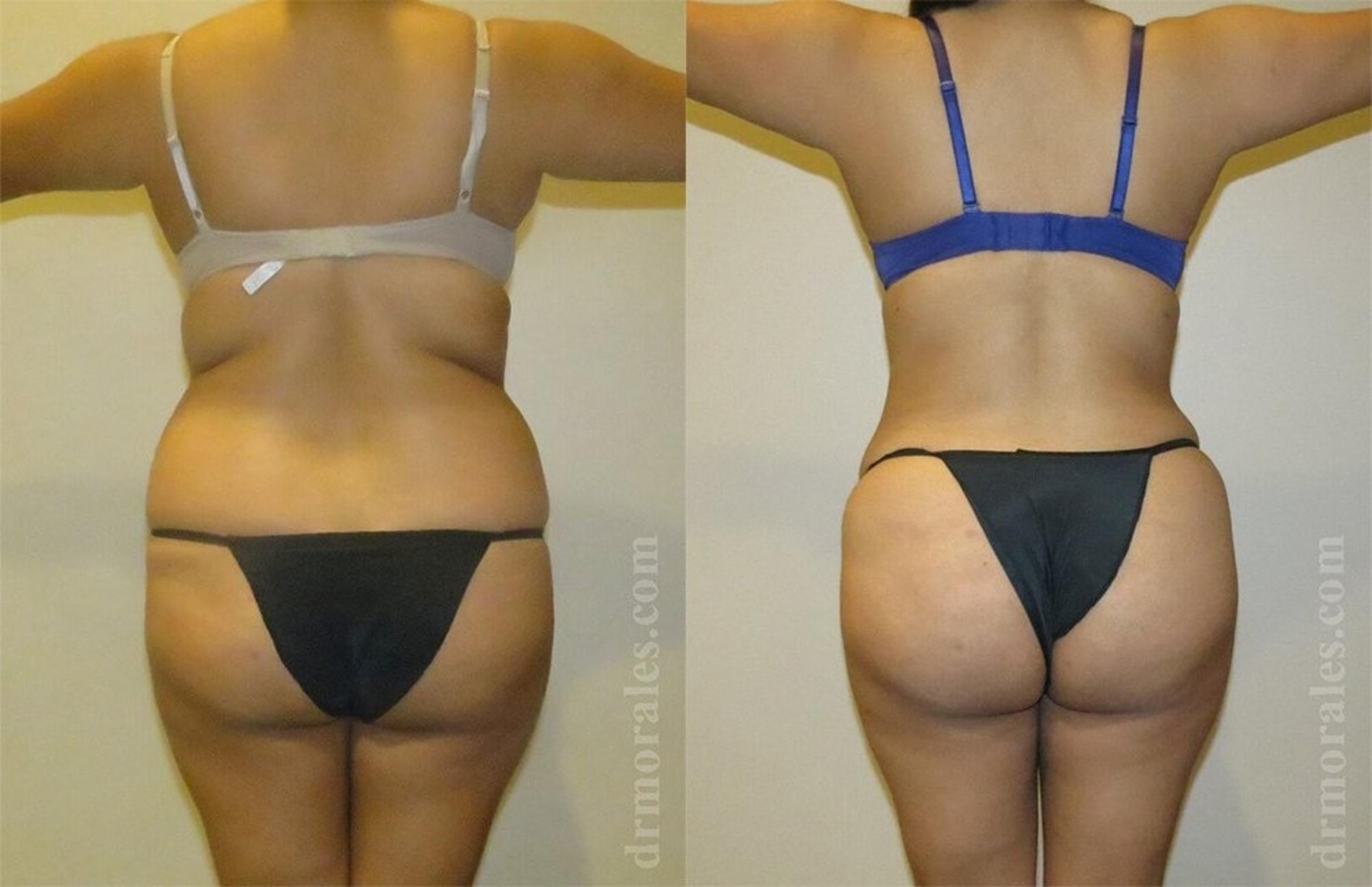 Before & After Liposuction Case 455 View 1 View in Houston, TX