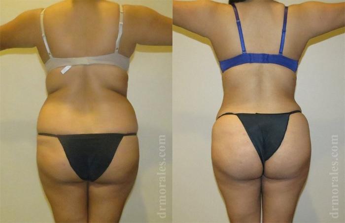 Before & After Liposuction Case 455 View 1 View in Houston, TX