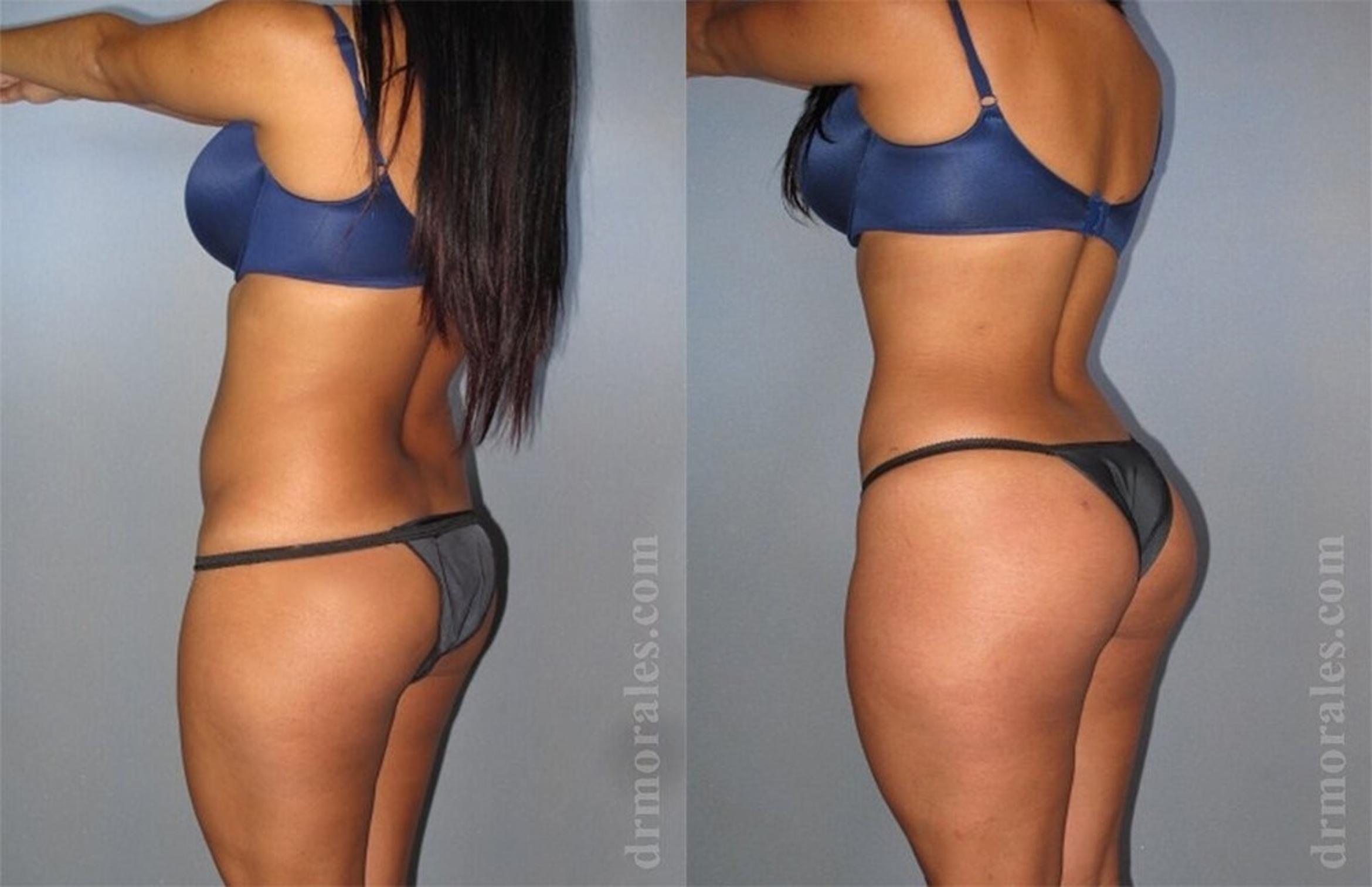 Before & After Liposuction Case 457 View 1 View in Houston, TX