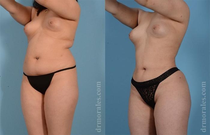 Before & After Liposuction Case 459 View 1 View in Houston, TX
