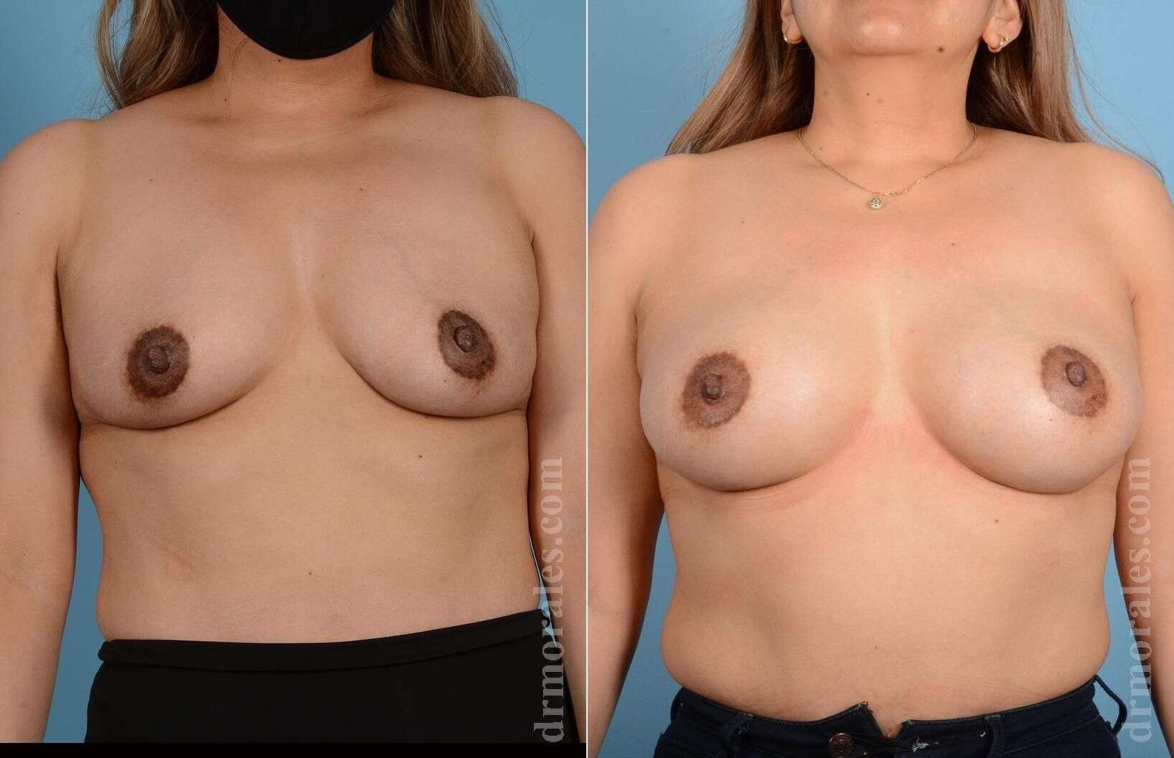 Before & After Breast Augmentation Case 102 View 1 View in Houston, TX