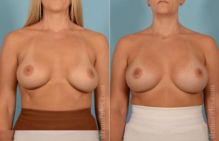Before & After Breast Revision Case 13 View 1 View in Houston, TX