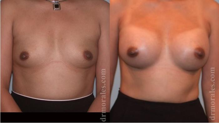 Before & After Breast Augmentation Case 38 View 1 View in Houston, TX