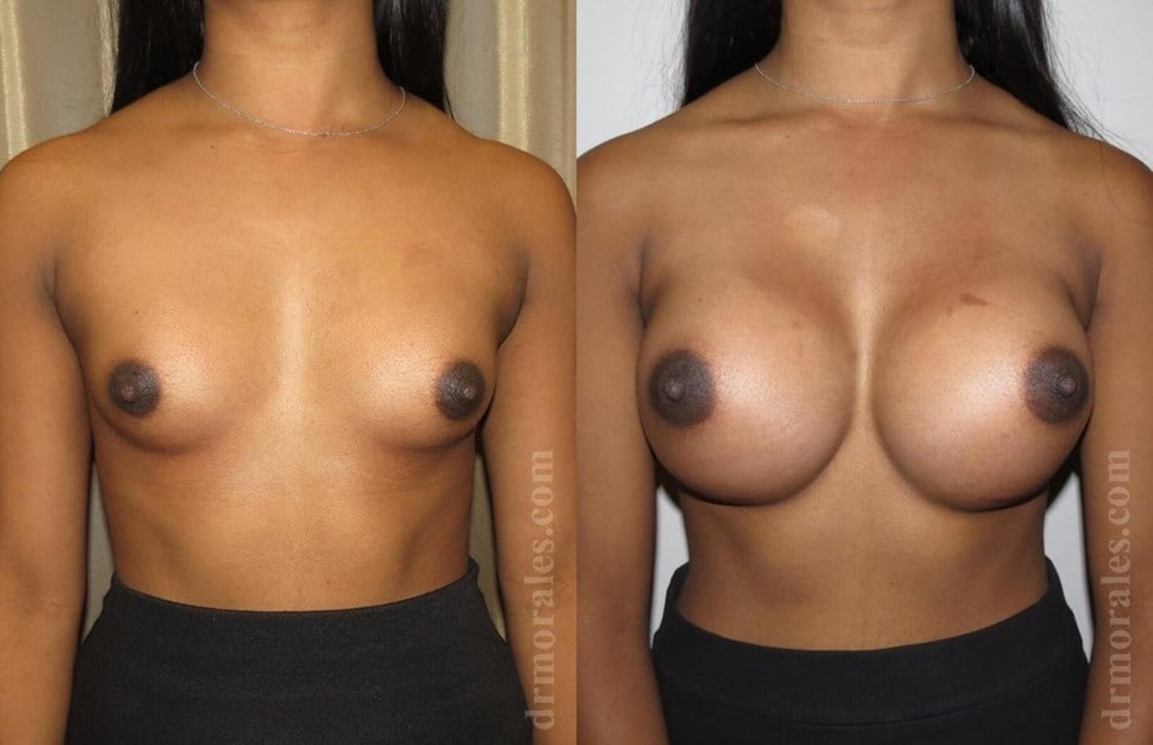 Before & After Breast Augmentation Case 582 View 1 View in Houston, TX