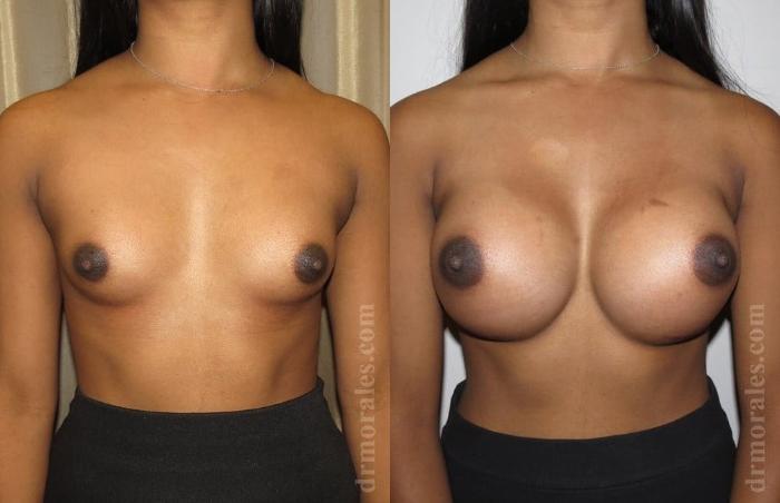 Before & After Breast Augmentation Case 582 View 1 View in Houston, TX
