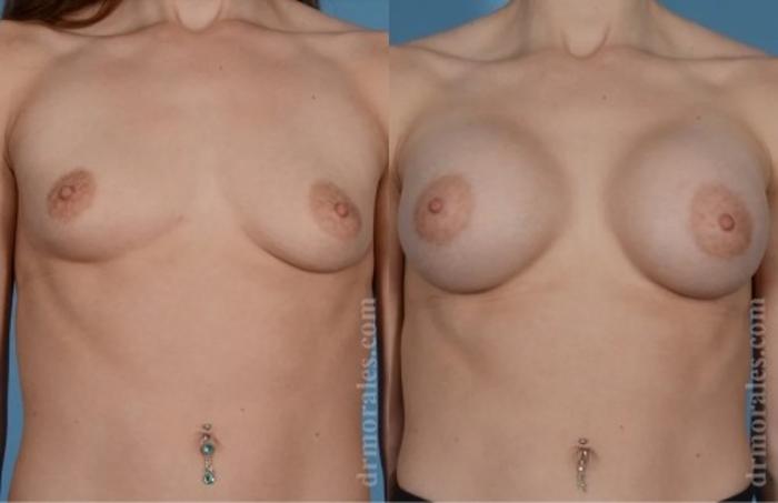 Before & After Breast Augmentation Case 747 View 1 View in Houston, TX