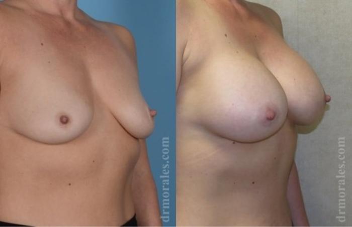 Before & After Breast Augmentation Case 748 View 1 View in Houston, TX
