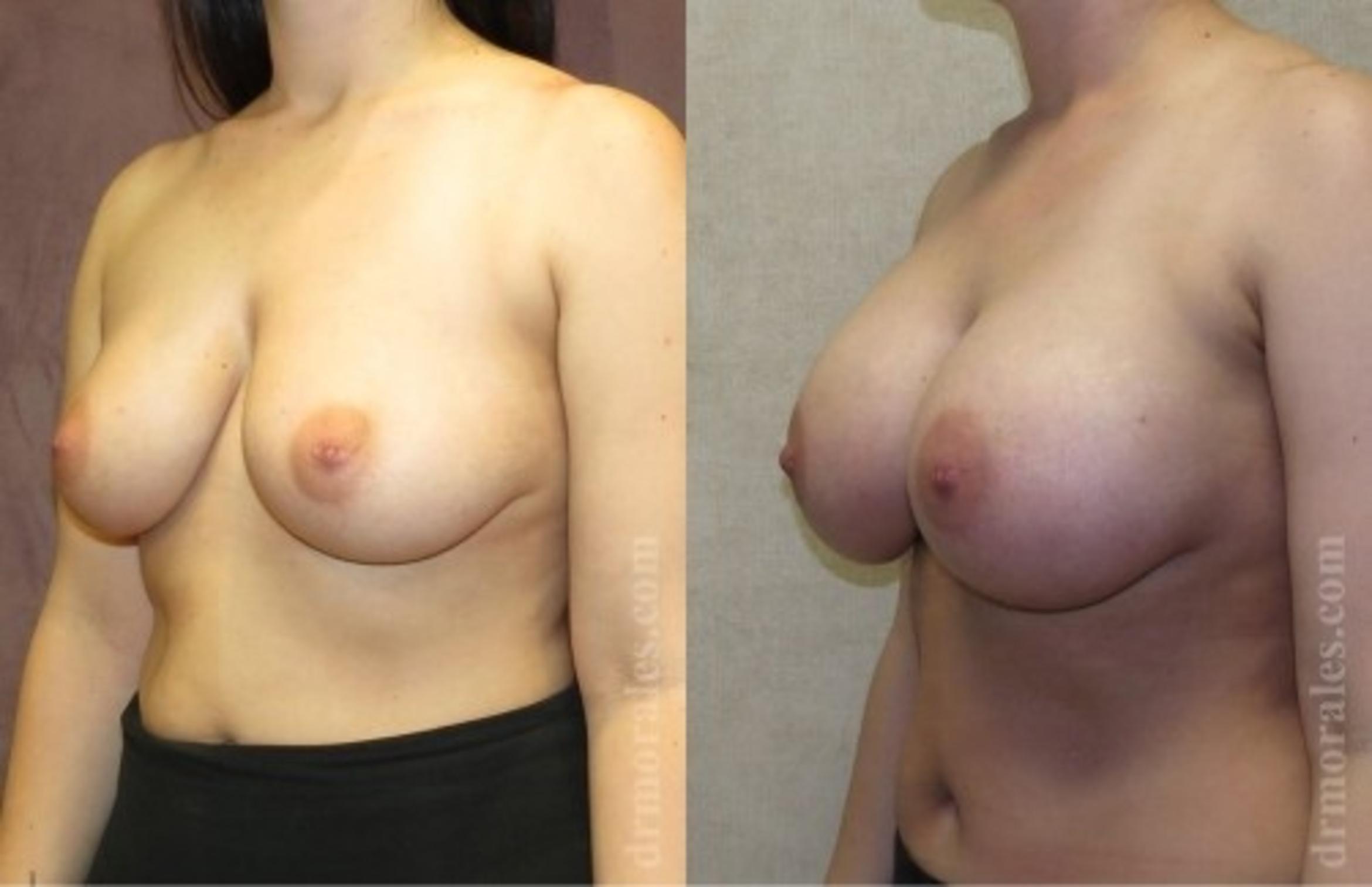 Before & After Breast Augmentation Case 751 View 1 View in Houston, TX