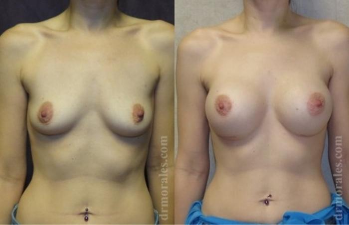 Before & After Breast Augmentation Case 752 View 1 View in Houston, TX