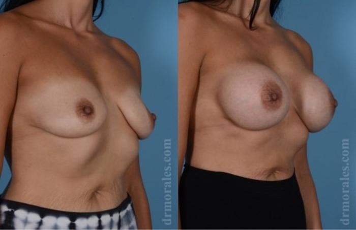 Before & After Breast Augmentation Case 753 View 1 View in Houston, TX