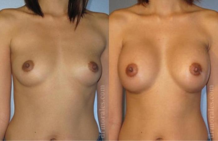 Before & After Breast Augmentation Case 754 View 1 View in Houston, TX