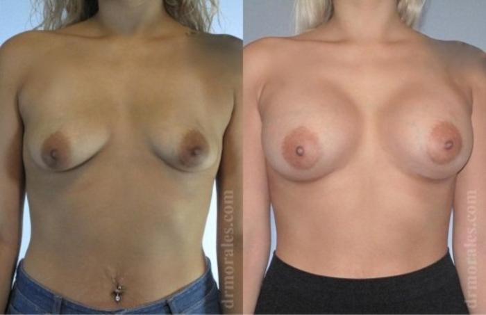 Before & After Breast Augmentation Case 755 View 1 View in Houston, TX