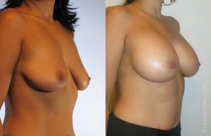 Before & After Breast Augmentation Case 757 View 1 View in Houston, TX
