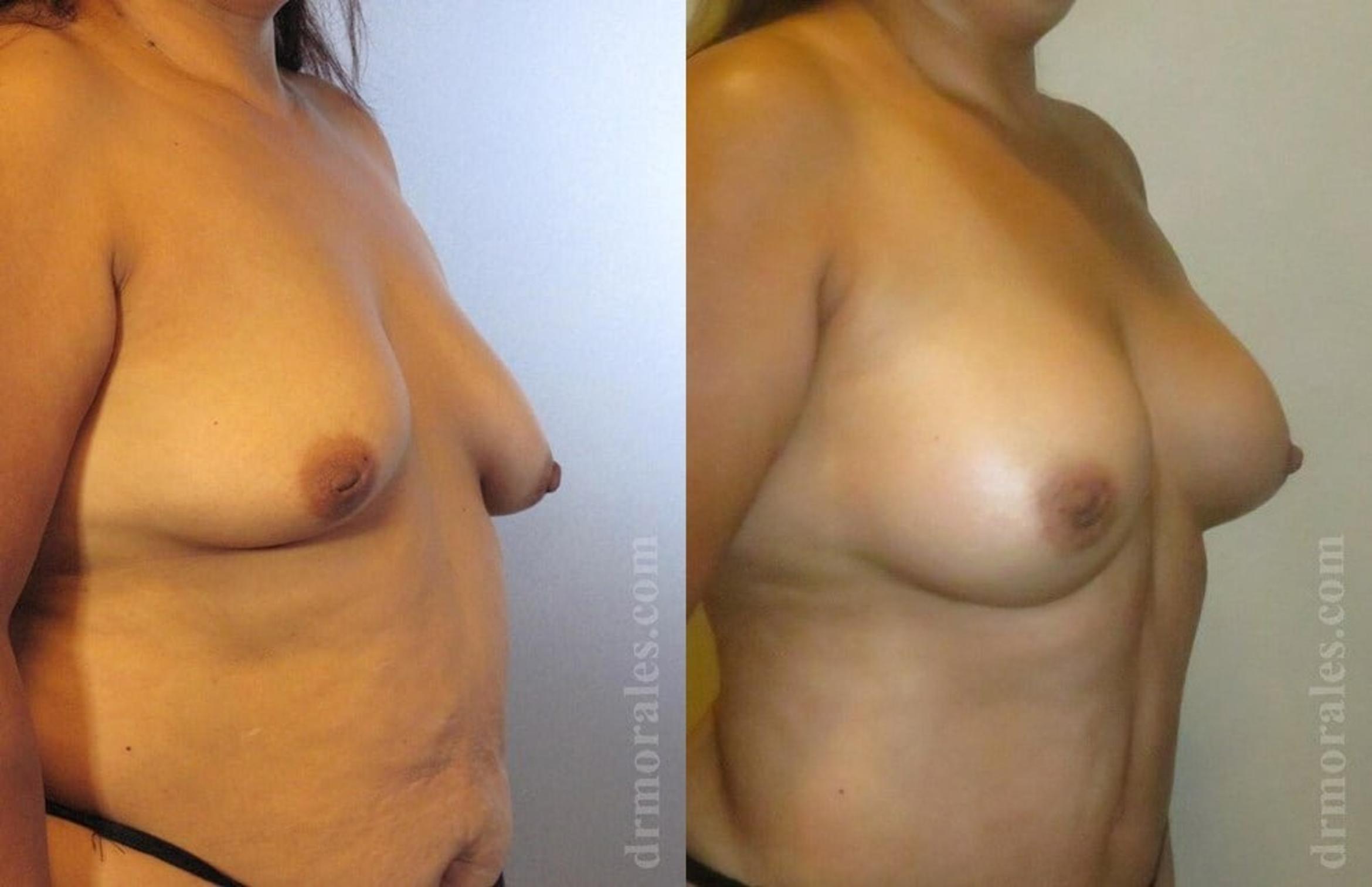 Before & After Breast Augmentation Case 758 View 1 View in Houston, TX