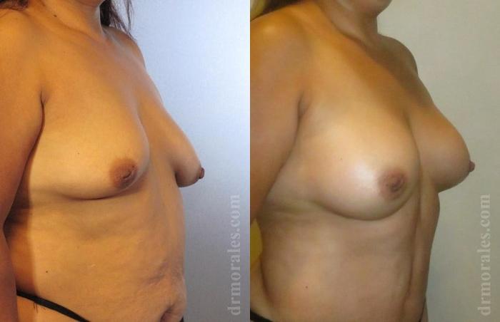 Before & After Breast Augmentation Case 758 View 1 View in Houston, TX