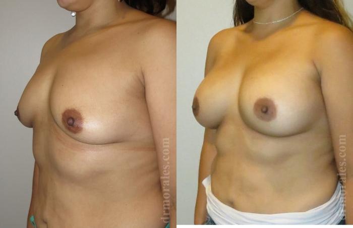 Before & After Breast Augmentation Case 759 View 1 View in Houston, TX