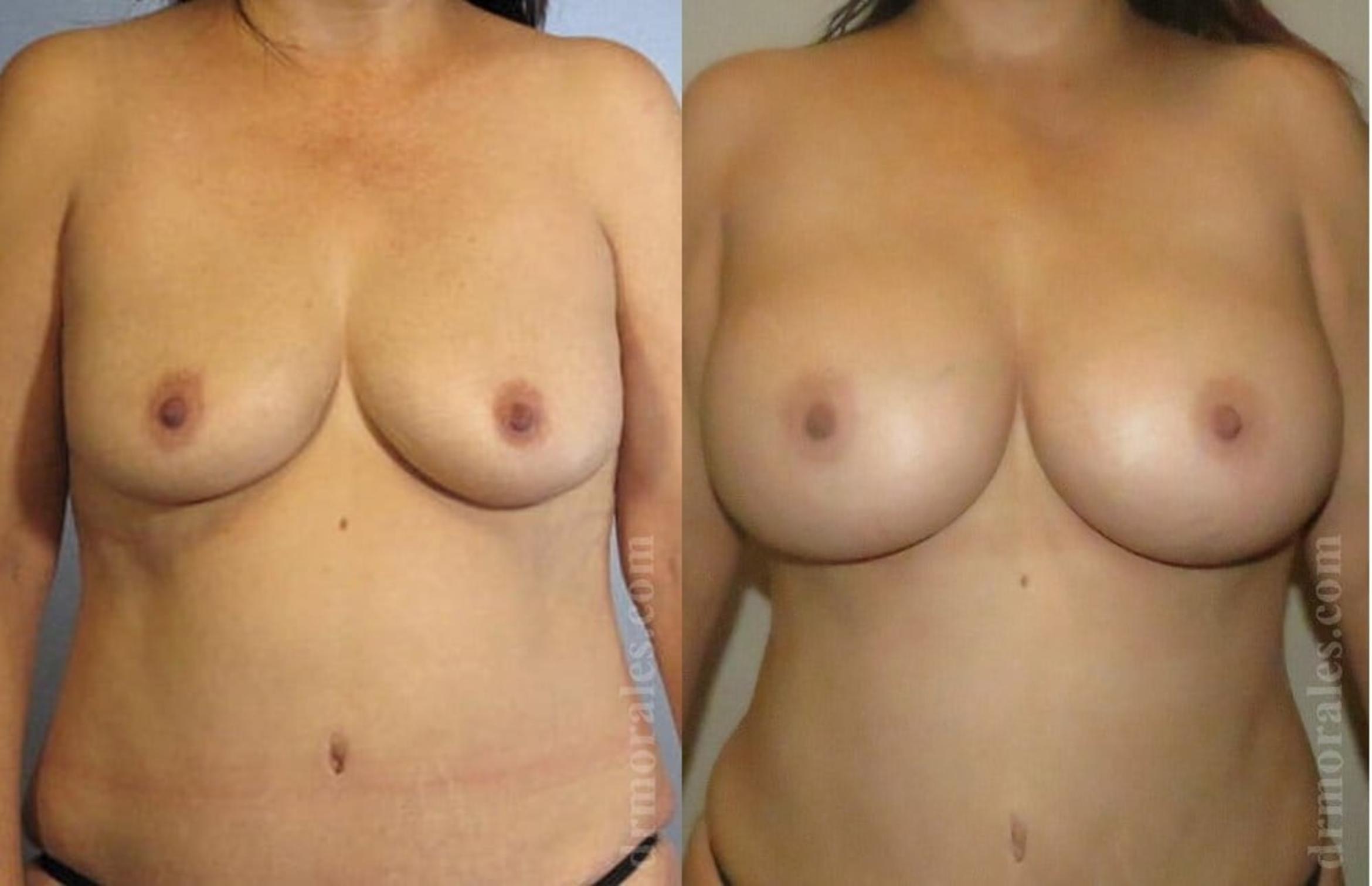Before & After Breast Augmentation Case 760 View 1 View in Houston, TX