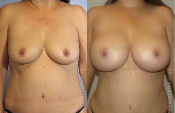 Before & After Breast Augmentation Case 760 View 1 View in Houston, TX