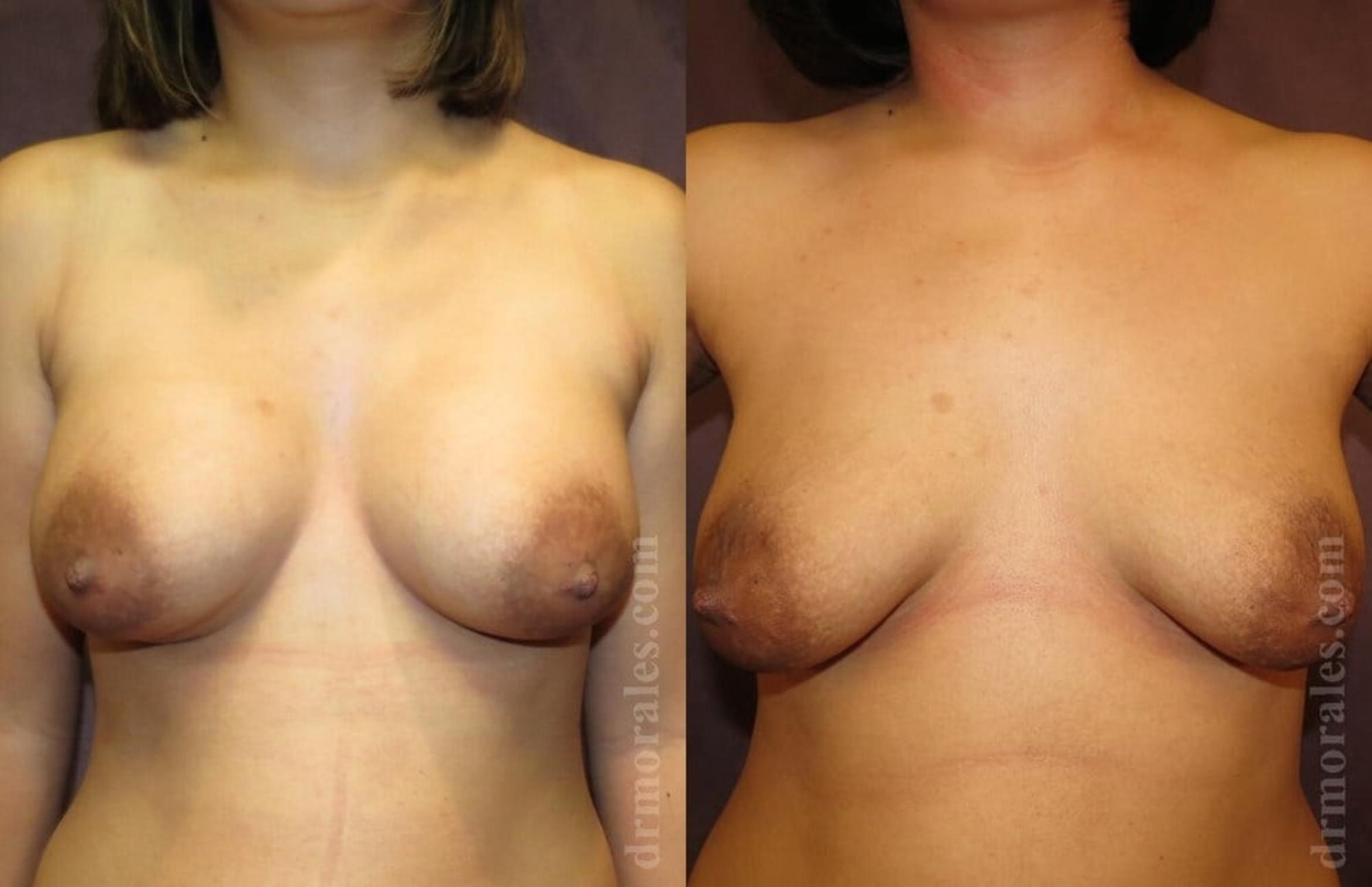 Before & After Breast Augmentation Case 761 View 1 View in Houston, TX
