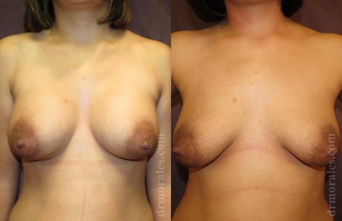 Before & After Breast Augmentation Case 761 View 1 View in Houston, TX