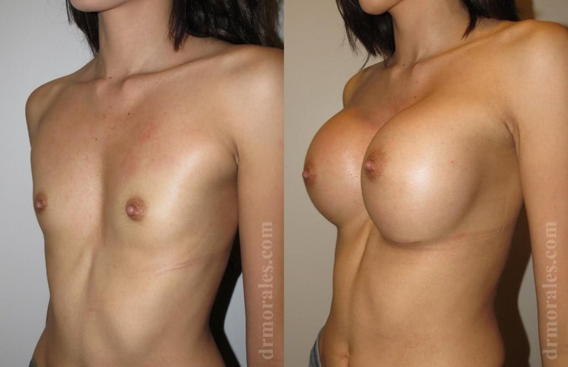 Before & After Breast Augmentation Case 762 View 1 View in Houston, TX