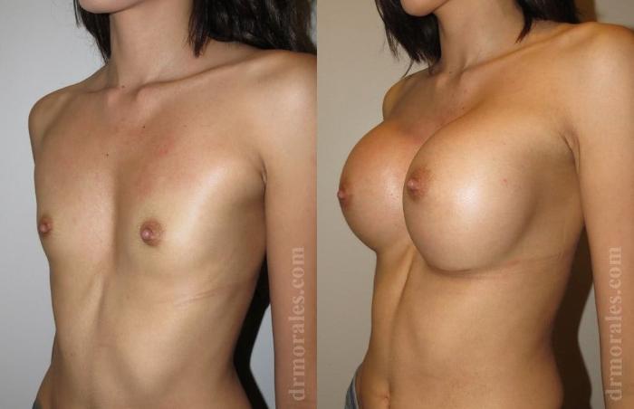 Before & After Breast Augmentation Case 762 View 1 View in Houston, TX