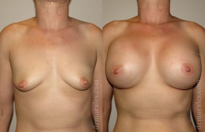 Before & After Breast Augmentation Case 764 View 1 View in Houston, TX